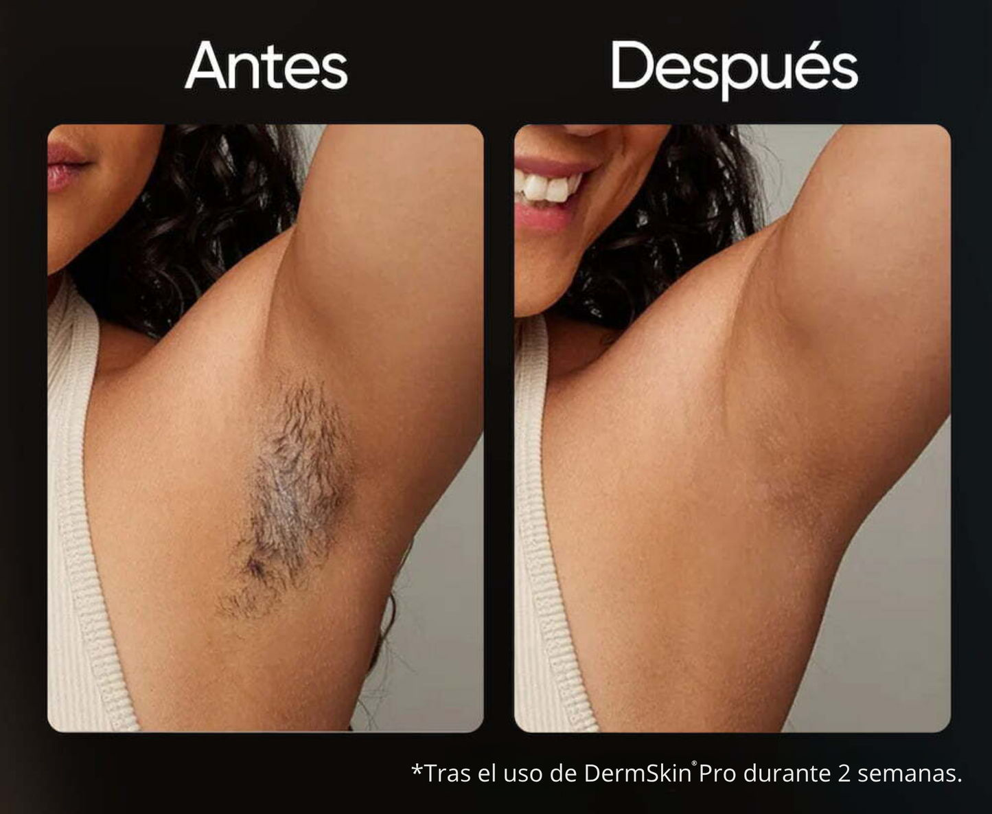 Depiladora IPL permanente