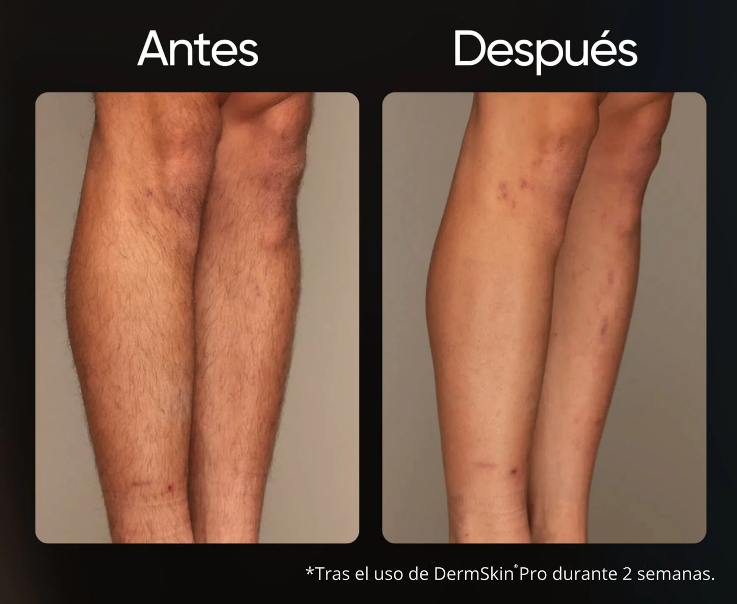 Depiladora IPL permanente