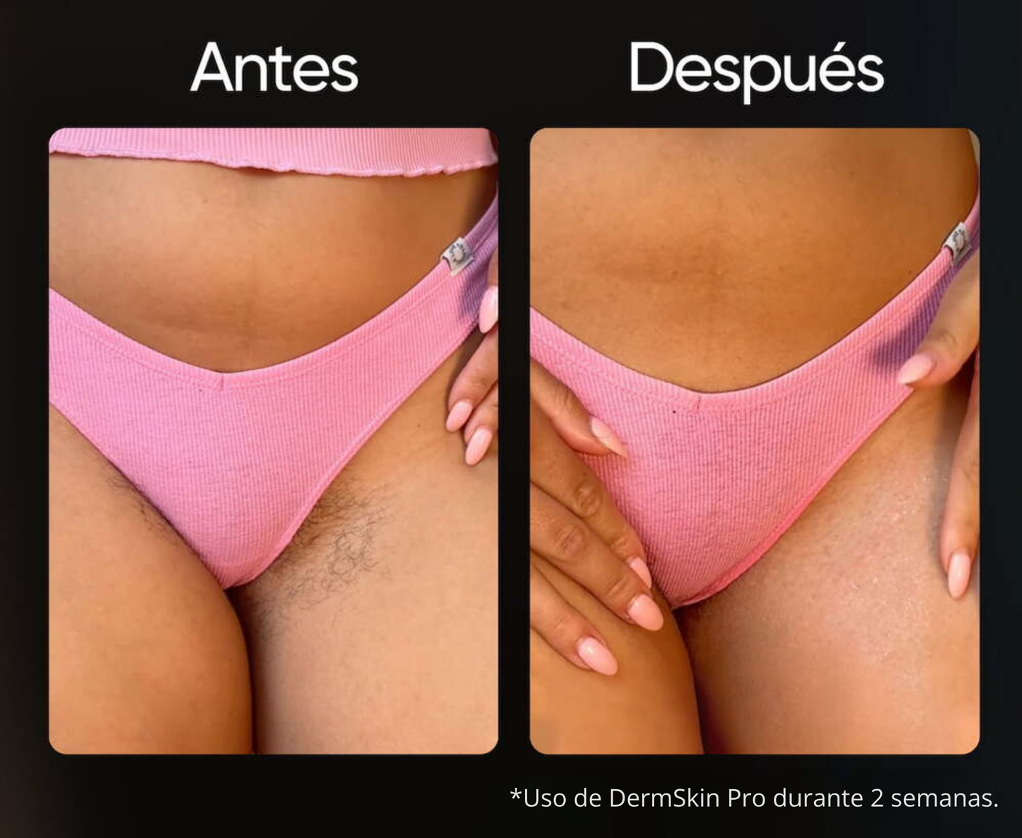 Depiladora IPL permanente