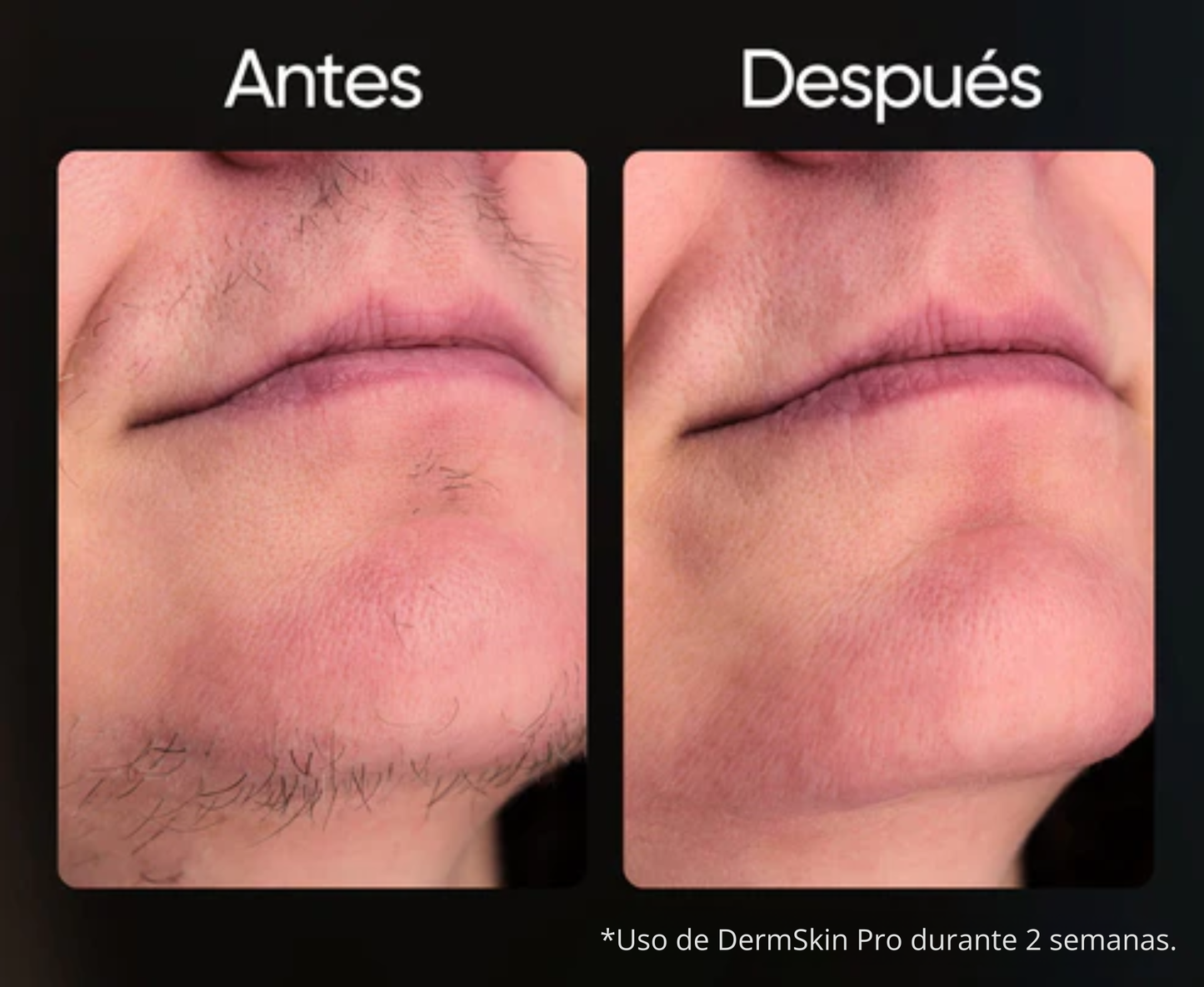Depiladora IPL permanente